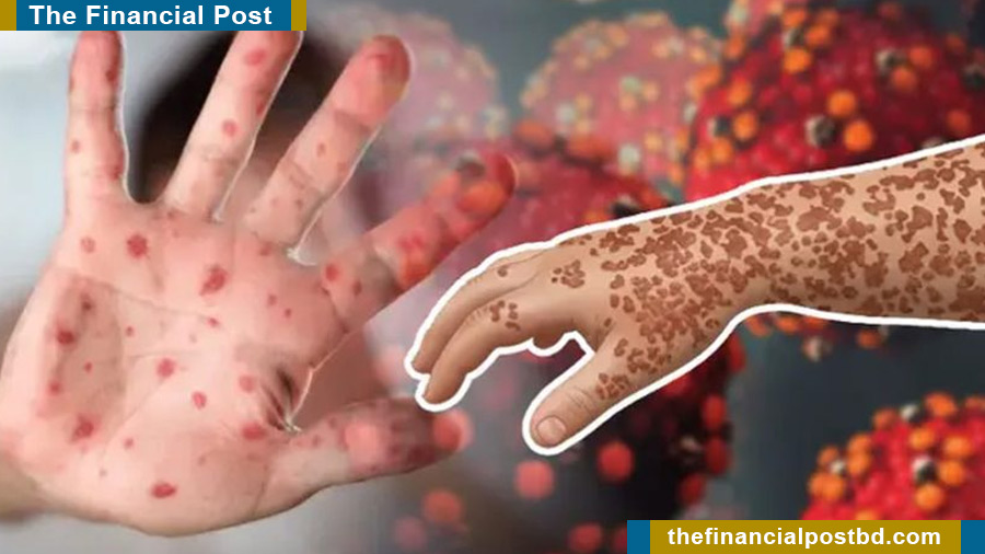 10 more children die of measles, symptoms in 24hrs